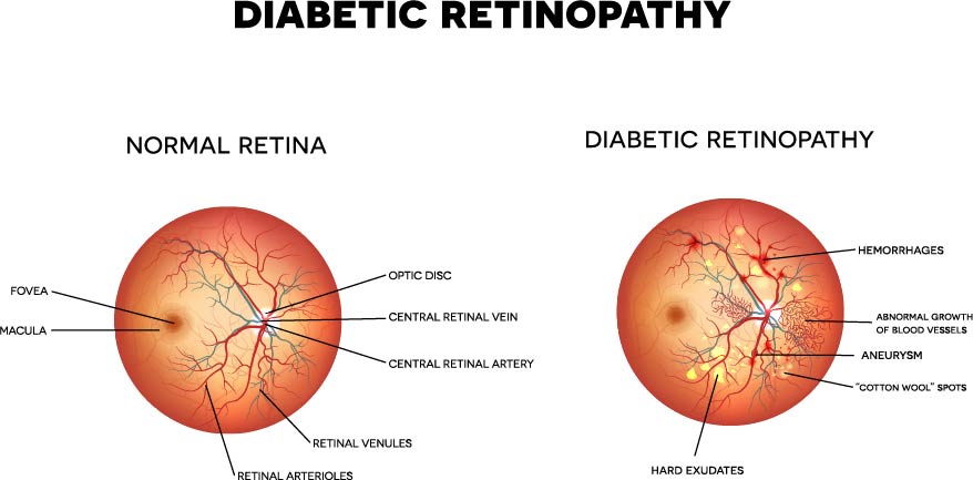 Diagram of a normal retina next to a diagram of a retina with diabetic eye problems including abnormal blood vessels and exudates