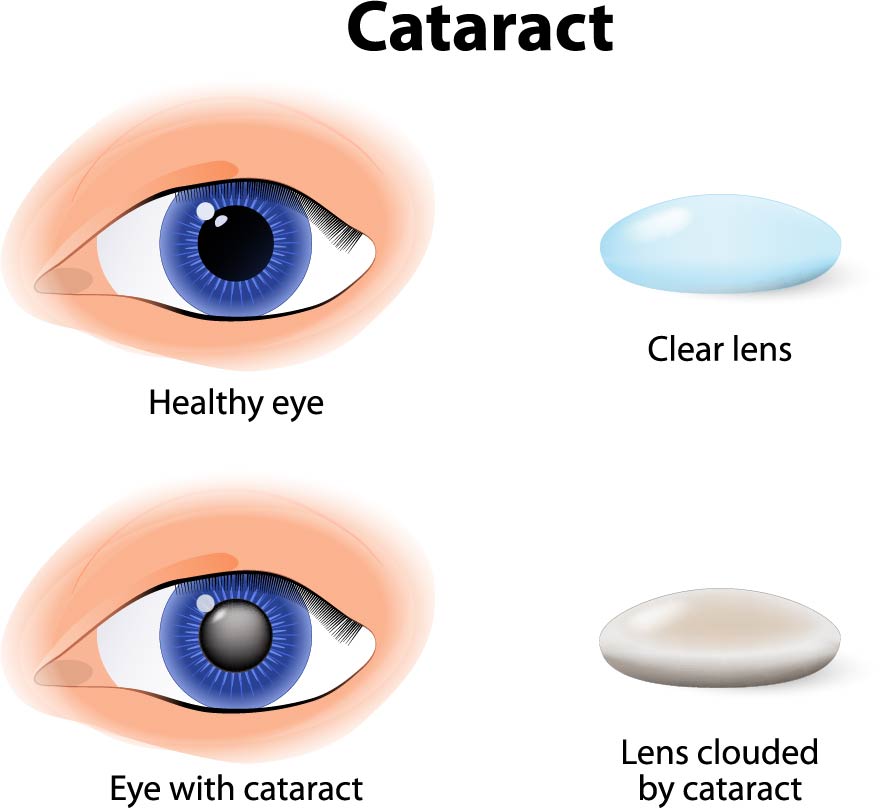 A diagram of a normal lens and a lens with a cataract which appears more milky