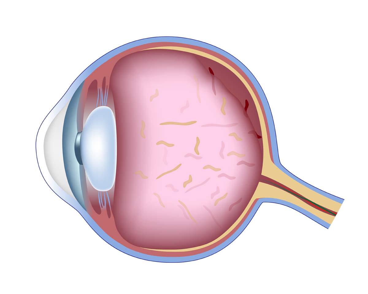 A diagram of an eye showing the vitreous gel with condensations and floaters in it.