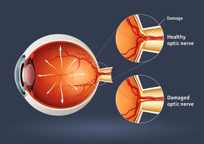A diagram of how glaucoma damages the eye by affecting the optic nerve