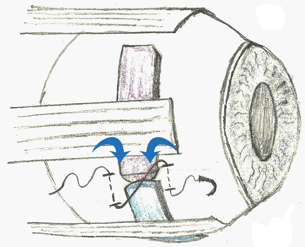 a diagram of a scleral buckle around an eye